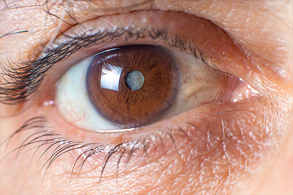 Cataracts Surgery in Fort Lauderdale