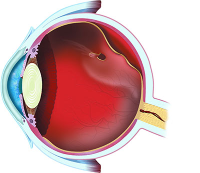 Fort Lauderdale Retinal Detachment