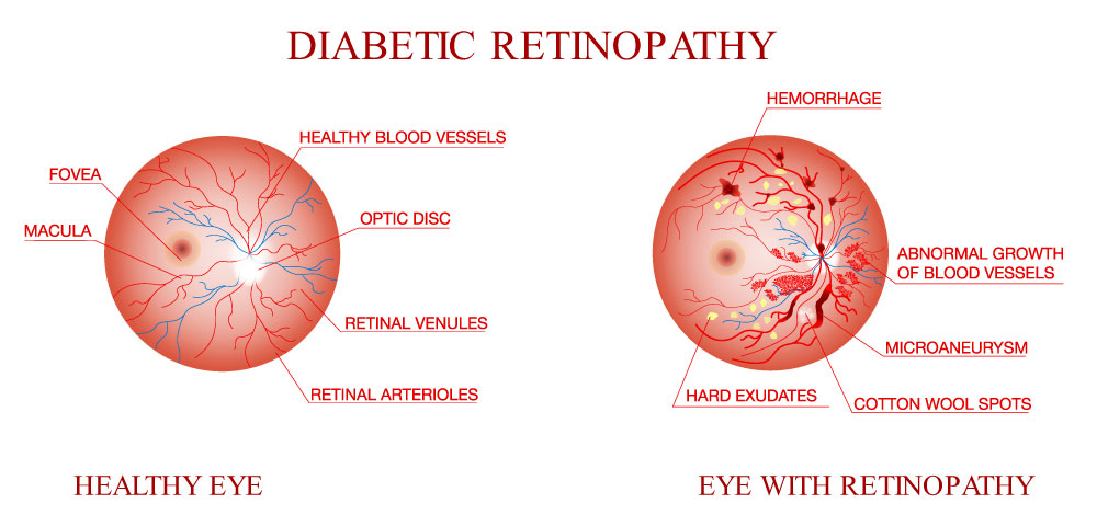 Diabetic Eye Care 33064