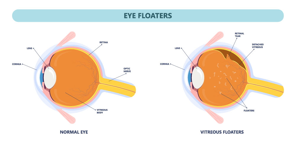 Eye Floaters Treatment Fort Lauderdale