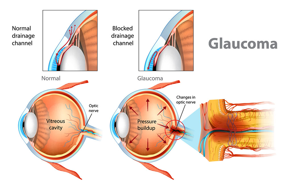 Glaucoma Treatment Fort Lauderdale