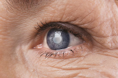 Glaucoma Treatment Fort Lauderdale
